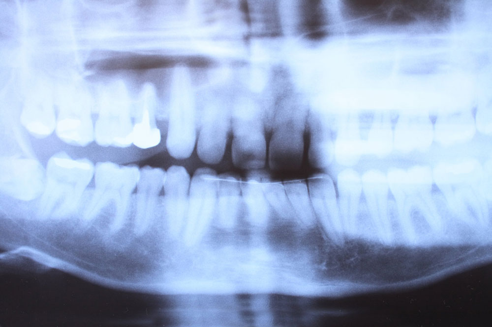 Revner i tænderne - Tandklinikken Brogade