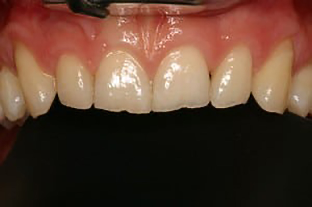 Tandslid - Tandklinikken Brogade