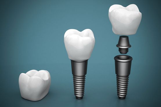 Implantater - Tandklinikken Brogade